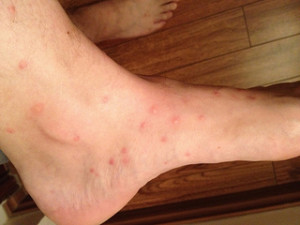 Flea bites on an ankle