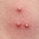 Close up of flea bites on a human